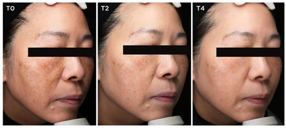 ALPHASCIENCE MELA BRIGHT [C+] 30 ML / 1 Fl Oz CYSTEAMINE SERUM for Melasma Hyperpigmentation